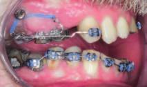 Na patro byl zaveden kotevní mikrošroub Dual Top JD (Jeil, Korea) 10 mm a vestibulárně zygomatický 4děrový implantát Synthes se síťkou (Orthodontic Bone Anchor, Korea) upevněný do kosti zygomatické