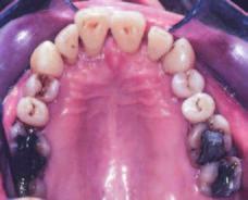 stupně, navíc byl zub 16 nedokonale endodonticky ošetřen.