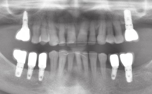 Obr. 32: Sagitální řez 3D CBCT v oblasti zubu 25 a implantátu v lokalizaci 26. Obr.