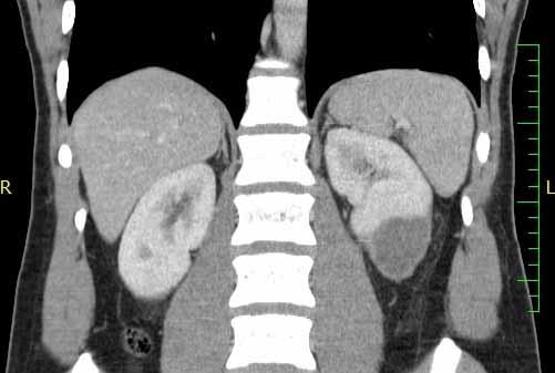 Průběh Vzhledem k nálezu na ultrazvuku doplněno CT břicha, kde popsána kortikální lacerace dolního segmentu levé ledviny 11 mm s rozsáhlým subkapsulárním hematomem 56 55 100 mm odpovídá poranění