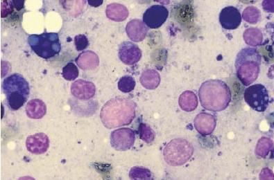 Lymfadenitida Zvýšený počet zánětlivých buněk v mízní uzlině nazýváme lymfadenitidou. Rozlišení mezi purulentní lymfangitidou a granulomatózní lymfangitidou se provádí podle typů zánětlivých buněk.