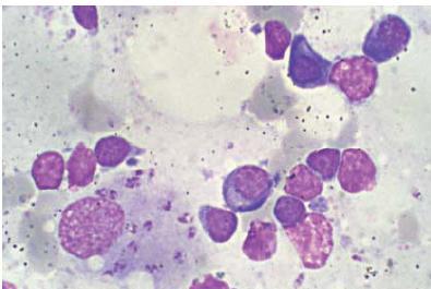 Granulomatózní lymfadenitida je obvykle charakterizována lehce reaktivní lymfoidní obraz a případně zvýšené množství makrofágů, epiteloidních buněk a mnohojaderných gigantických buněk.