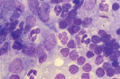 Obr. 7 Granulomatózní lymfadenitis zapříčiněná mykobakteriání infekcí u kočk. Vidímě několik velkých histiocytů s několika bakteriemi v levé části snímku.