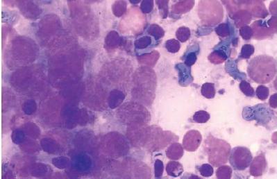 Metastatické malignity Kompletní průzkum mízních uzlin, jestli neobsahují metastázy je zbytečně vynaložené úsilí, protože metastázy prochází lymfatickým systémem.