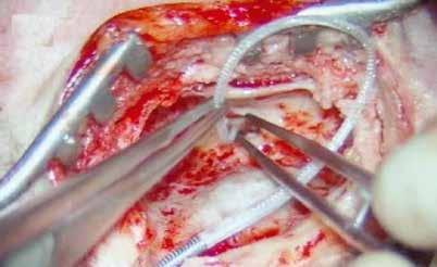 Anny v Brně pacientům s nejtěžšími poruchami sluchu pomáhají v poradně Centra kochleárních implantací na Klinice otorinolaryngologie a chirurgie hlavy a krku FNUSA a LF MU.