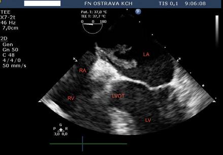 VYUŽITÍ STERILNÍHO KRYTÍ TEGADERMTM U PACIENTŮ PO IMPLANTACI CIED A JEHO VLIV NA VÝSKYT RANNÝCH INFEKCÍ DROZDOVÁ A., JIRAVSKÝ O., FRANKOVÁ J., CHOVANČÍK J., ŠKŇOUŘIL L.
