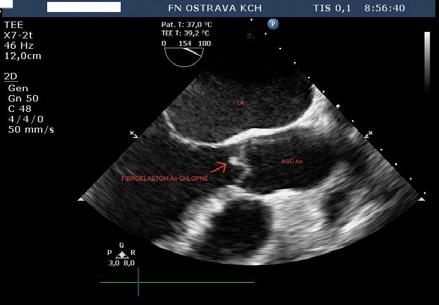 , Třinec Poruchy rytmu, kardiostimulace Cíl: Prokázat nižší výskyt ranných infekcí u pacientů po implantaci kardiostimulátoru či defibrilátoru při použití krytí TegadermTM Obr.