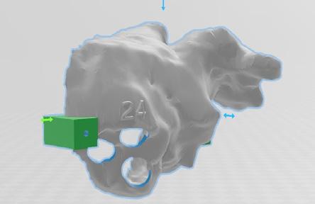 , Třinec Poruchy rytmu, kardiostimulace Cíl: Metodika 3D modelování a následného 3D tisku levé síně pro retrospektivní porovnání implantovaných pacientů okluderem.