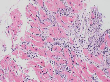 MYOKARDITIDA JAKO PŘÍČINA SRDEČNÍHO SELHÁNÍ U MLADÉHO MUŽE OD STANOVENÍ DIAGNÓZY K TRANSPLANTACI SRDCE AIGLOVÁ R., LAZÁROVÁ M., TÁBORSKÝ M., FLODROVÁ P. 2, FLODR P. 2 I.