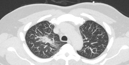 (intermediate-high risk) a flebotrombózu dolních končetin. Na EKG suspektní známky plicní embolie. Laboratorně elevace D-dimerů, troponinu I, NT-proBNP a CRP. Vstupní antigen SARS-CoV 2 negativní.
