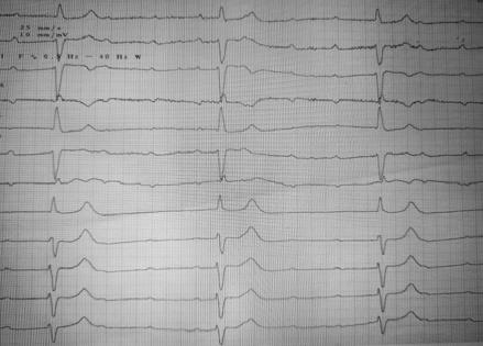 KOMPLETNÍ AV DISOCIACE JAKO NEZVYKLÝ EKG PROJEV KOMPLETNÍHO TROMBOTICKÉHO UZÁVĚRU PROXIMÁLNÍ ČÁSTI RAMUS INTERVENTRICULARIS ANTERIOR (RIA). NYKL R., RICHTER D., SLUKA M., OSTŘANSKÝ J., NÁPLAVA R.