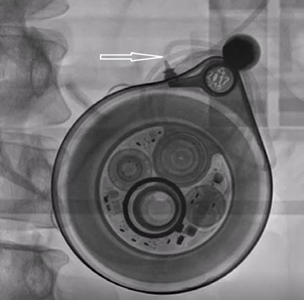 DYSFUNKCE IMPLANTOVANÉ TREPROSTINILOVÉ PUMPY PO MECHANICKÉM INZULTU U PACIENTKY S PLICNÍ ARTERIÁLNÍ HYPERTENZÍ PŘEČEK J., HUTYRA M., RADA M., TÁBORSKÝ M. I. interní klinika kardiologická, FN Olomouc Plicní hypertenze Úvod: Treprostinil je prostacyklinový analog používaný k léčbě plicní arteriální hypertenze.