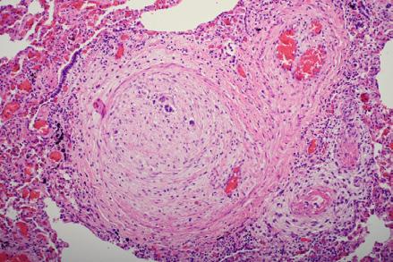 interní klinika kardiologie a angiologie, Všeobecná fakultní nemocnice, Praha Plicní hypertenze Obr.
