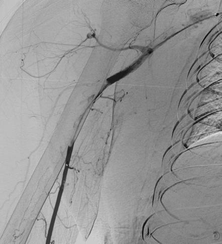 ROZSÁHLÁ PARADOXNÍ EMBOLIZACE PŘI OTEVŘENÉM FORAMEN OVALE ŠPALEK M., DOSTÁL J., TROPP M.