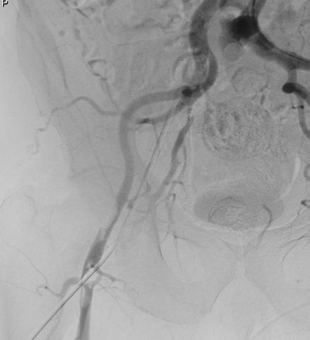CTA vyšetření plicnice s nálezem masivní bilaterální plicní embolie do odstupů všech segmentálních plicních arterií. Provedena emergentní systémová trombolýza s ústupem dušnosti.