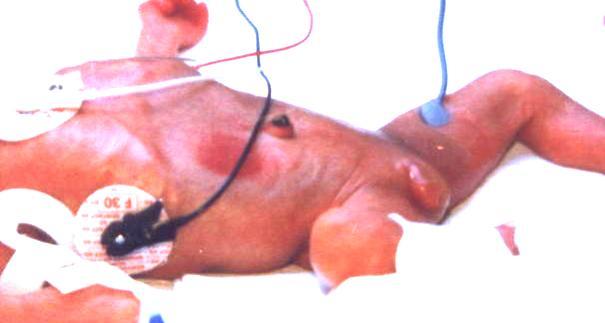 Typ rány Kontaktní podráždění = zvláštní kategorie Medical Adhesive Related Skin Injury (MARSI): nealergické - v důsledku chemického