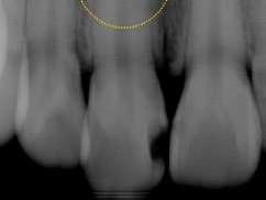 dentinu a cementu