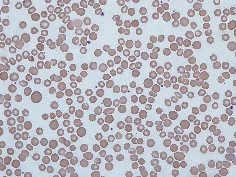 Anisocytosis: erytrocyty rozdílné