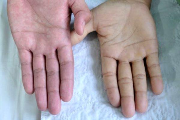 Anémie (chudokrevnost) = nedostatek funkčního hemoglobinu v krvi Málo ery a/nebo nízký hematokrit a/nebo nefunkční hemoglobin Porucha tvorby ery (proliferace, diferenciace), zvýšená destrukce ery,
