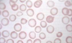 Sideropenická anémie: Způsobená nedostatkem Fe 2+ nedostatečná tvorba hemoglobinu hypoxie tkání stimuluje tvorbu erytropoetinu zvýšená tvorba erytrocytů s
