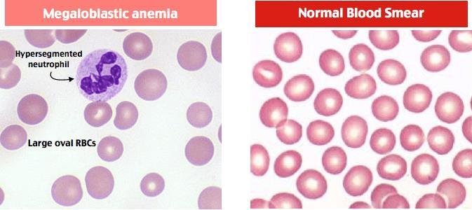 nezralých erytrocytů (megaloblastů) v kostní dřeni