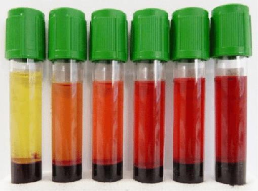 Hemolýza Zánik červené krvinky porušením její membrány vede k vylití obsahu cytoplasmy erytrocytů Staré fragilní ery jsou zachytány a zpracovány v červené