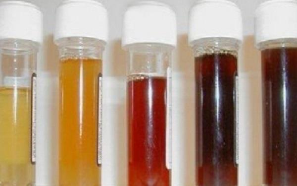 haptoglobin nestačí a dochází k filtraci hemoglobinu ledvinami a jeho ztrátě močí (hemoglobinurie), ztrátě železa, ucpávání tubulů a poškození ledvin