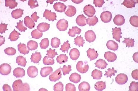 Poikylocytosis: nepravidelné tvaru