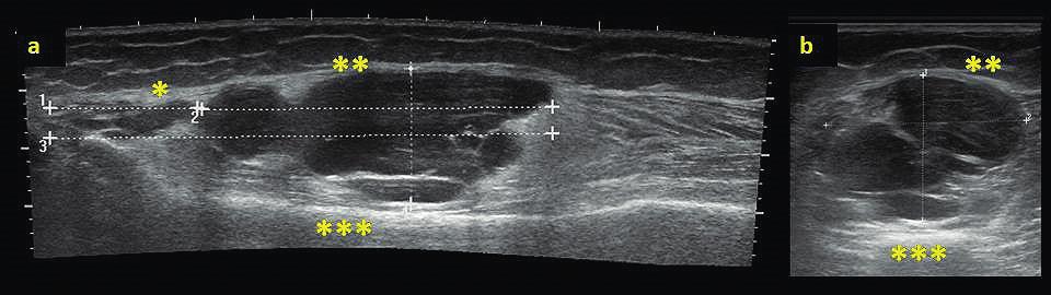 komunikací s kolenním kloubem; b podélný panoramatický řez Zhodnocení problematiky Do sledovaného souboru byli zařazeni pacienti s histologicky verifikovanými myxoidními nádory měkkých tkání, kteří