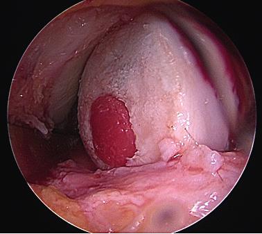Maximální průměr implantátu činí 15 mm což je v mnoha případech rozměr nedostačující.