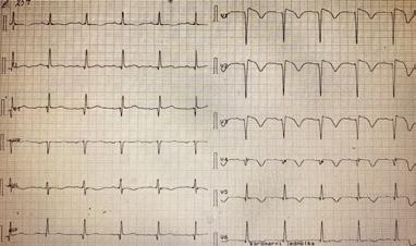 BRUGADA SYNDROM U PACIENTKY S MYOTONICKOU DYSTROFIÍ II