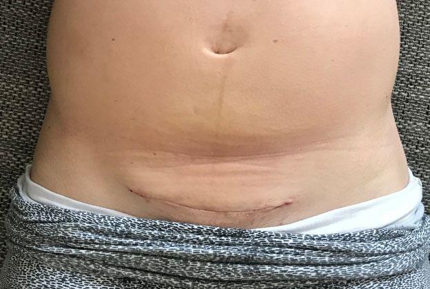 má možnost provádět samostatnou tlakovou masáž po celé délce jizvy 3x denně po dobu 10 minut. Účinek lze očekávat po 1-2 měsících.