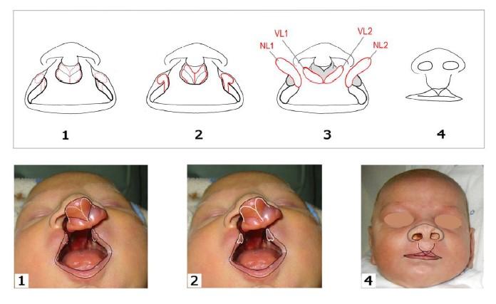 vestibulum, a dva laloky (NF 1, NF 2), prohlubující boky a spodinu nosní (Borský, 2014). Po operaci nosí jedinci silikonové nostrily, které zachovávají tvar korigované nosní přepážky (Borský et al.