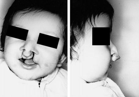 nedostatkem funkce svěracího svalu m. orbicularis oris, což způsobuje extrémní abnormality v poloze a funkci premaxily (Cosman, 1984).