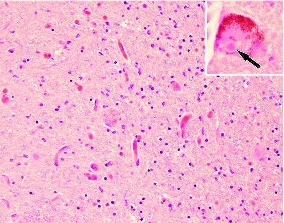 3.3 Patofyziologie při onemocnění Parkinsonovou nemocí Charakteristickým znakem PD je porucha bazálních ganglií, přesněji ztráta dopaminergních neuronů v SN, tedy nedostatek neurotransmiteru