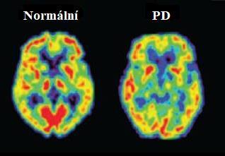 Obrázek 7: Molekulární zobrazení metabolismu glukózy metodou pozitronové emisní tomografie [59]