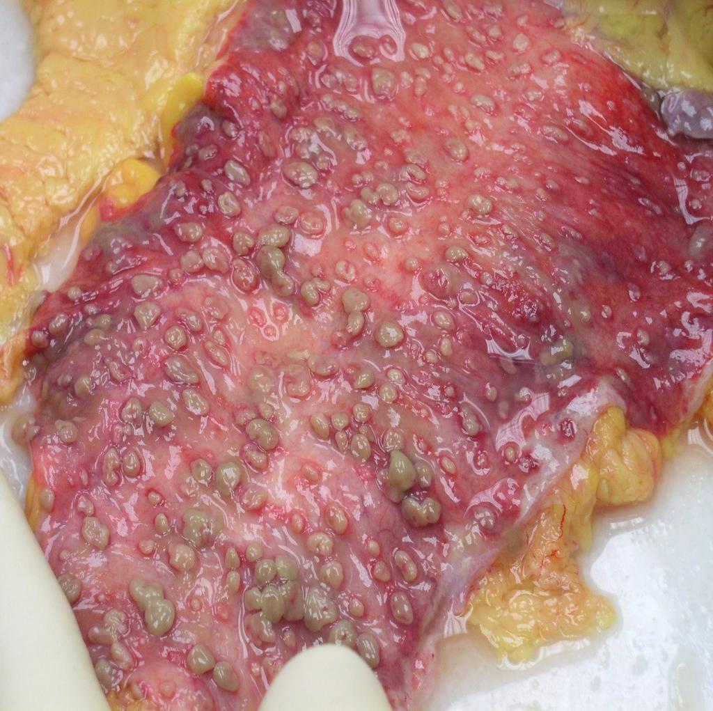 Pseudomembranózní kolitida