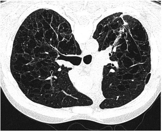 Na Kliniku pneumológie a ftizeológie sa pacient dostavil až o tri mesiace, kedy bol odoslaný ambulantným pneumológom za účelom zváženia indikácie na transplantáciu pľúc.