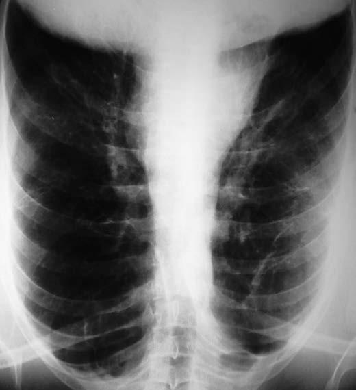 Obr.4: RTG počas druhej hospitalizácie na Klinike pneumológie (1. október 2014) Obr.