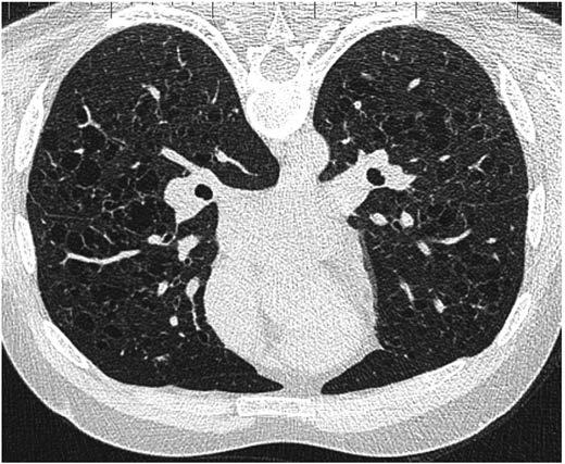 recidivujúcimi pneumotoraxami. Až tretia operácia a pri nej realizovaná druhá biopsia pľúc potvrdila u pacienta diagnózu LCH.