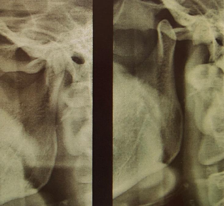 Obrázek 2 Rentgenový snímek s hypermobilním kloubem, vpravo s otevřenými ústy. Je zde viditelná hlavice pod kloubním vrcholem (Machoň a Hirjak, 2014, s.