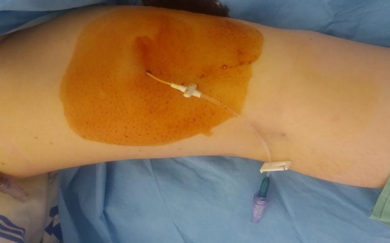 Dezinfekce Doporučovaná dezinfekce - Chlorhexidin