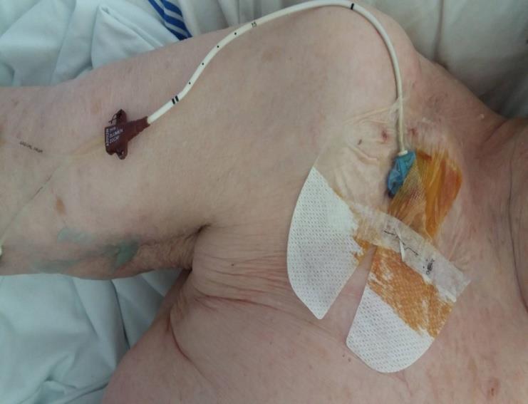 Možnosti fixace katétru Fixace stehy Nejvíce využívaná Stehy jsou vstupní bránou infekce Nekomfortní pro pacienta Nejsou 100% zárukou nevytažení katétru Bezstehová