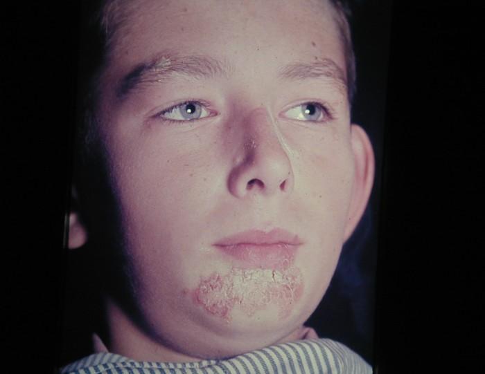 Impetigo
