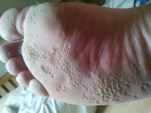 Keratoma sulcatum - pitted keratosis - v teplých obdobích a