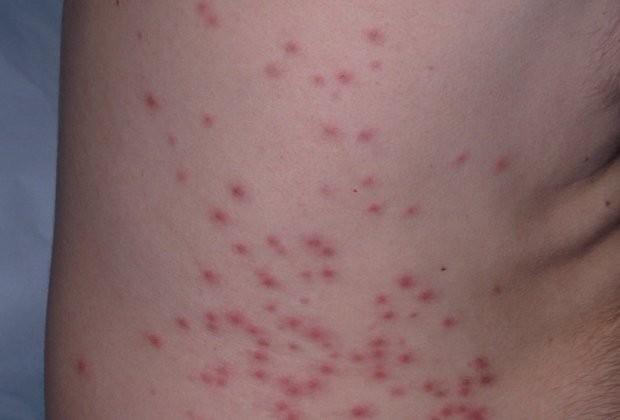 Hot tube folicuillitis - po pobytu ve špatně udržovaných a málo chlorovaných bazénech, vířivkách a aquacentrech - za 1 2 dny po expozici -