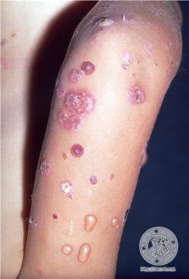 Impetigo
