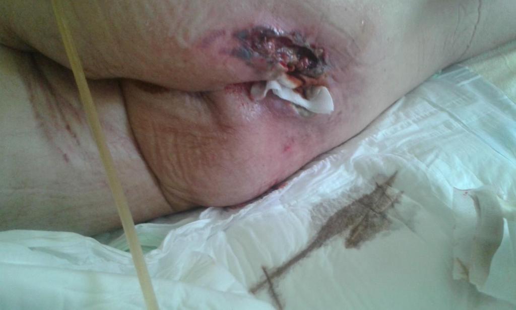 Příloha D péče o dekubitus d Pacientce byl dekubitus vyplněn sterilními