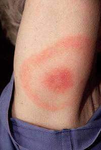 Klíště, borrelioza,