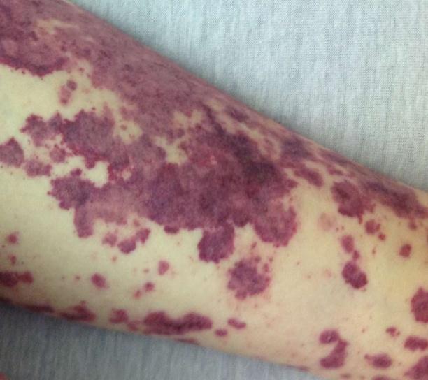 Běžná a záludná onemocnění u dětí Záněty mozku a mozkomíšních plen meningitidy a encefalitidy jsou obvykle způsobeny viry (klíšťová enc.